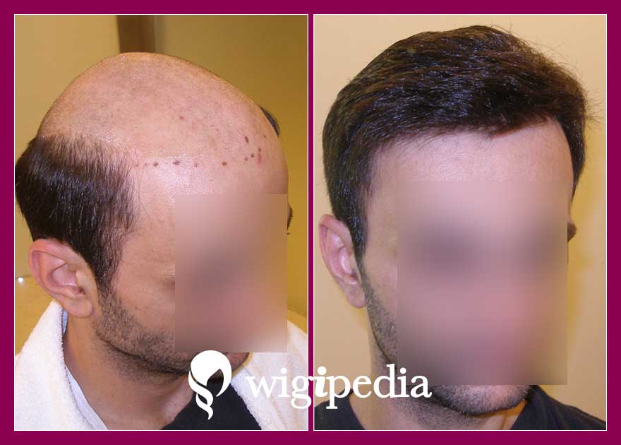 peruces-prosthetiki-malliwn-eshop-wigipedia-apotelesmata-andres-prin-meta-020902PG-001