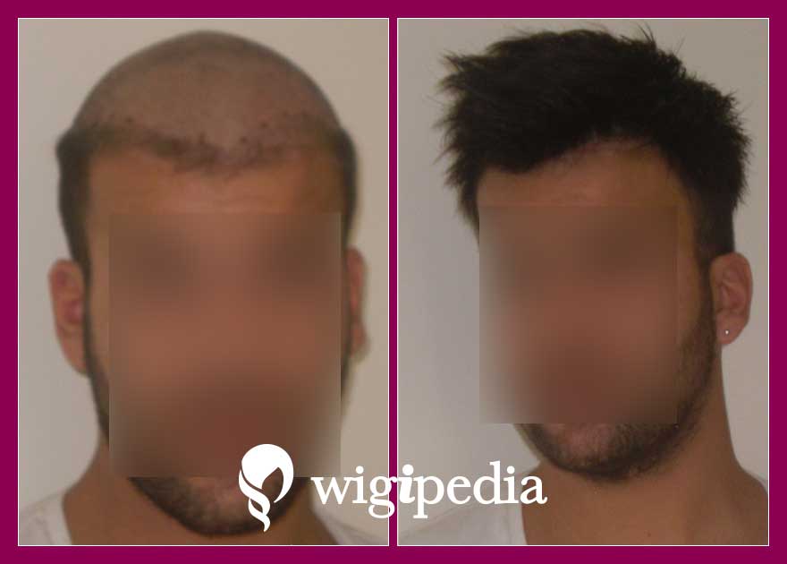 peruces-prosthetiki-malliwn-eshop-wigipedia-apotelesmata-andres-prin-meta-021001PG-001