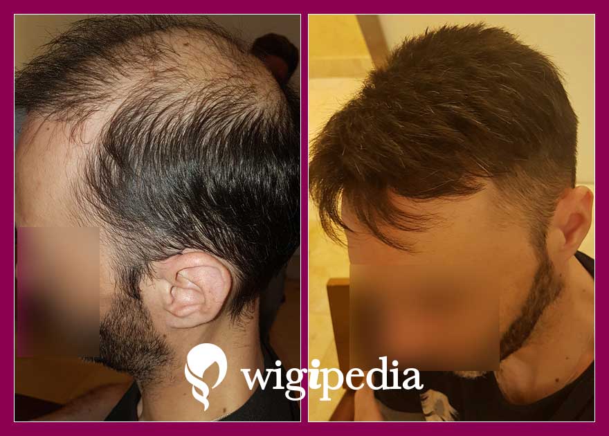 peruces-prosthetiki-malliwn-eshop-wigipedia-apotelesmata-andres-prin-meta-023245PG-002