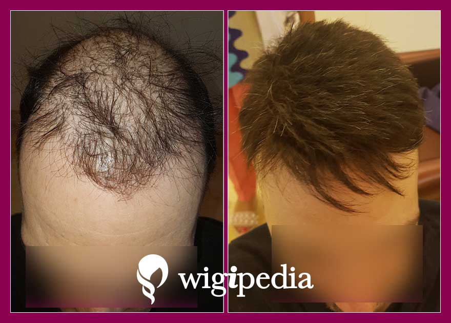 wigs-hair-prosthesis-eshop-wigipedia-results-men-before-after-023245PG-004