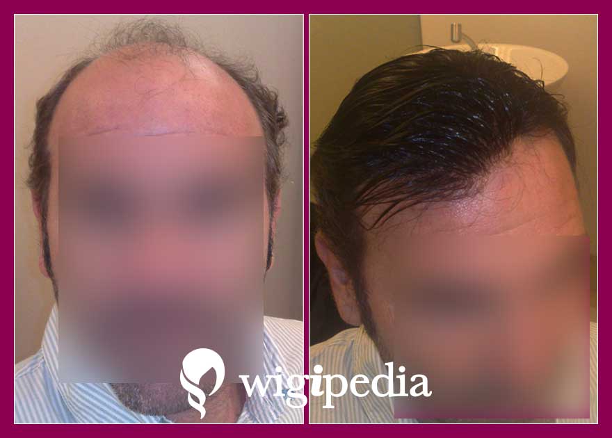 wigs-hair-prosthesis-eshop-wigipedia-results-men-before-after-029876PG-001