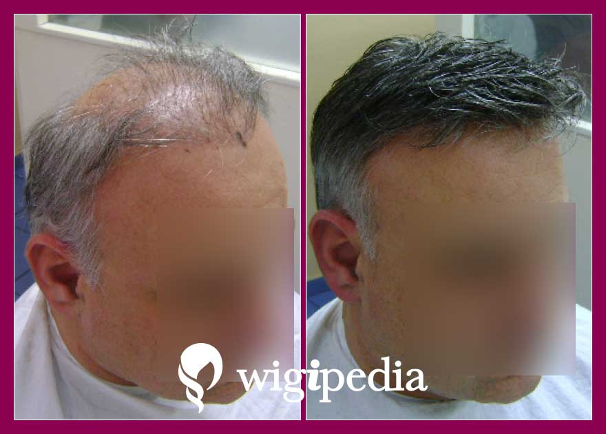 wigs-hair-prosthesis-eshop-wigipedia-results-men-before-after-030096PG-001