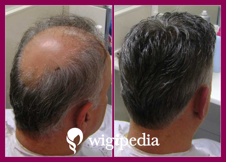 wigs-hair-prosthesis-eshop-wigipedia-results-men-before-after-030096PG-002