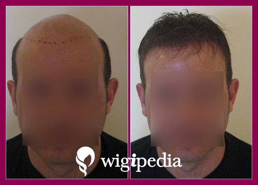 wigs-hair-prosthesis-eshop-wigipedia-results-men-before-after-031039PG-001