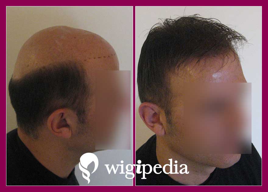 wigs-hair-prosthesis-eshop-wigipedia-results-men-before-after-031039PG-002
