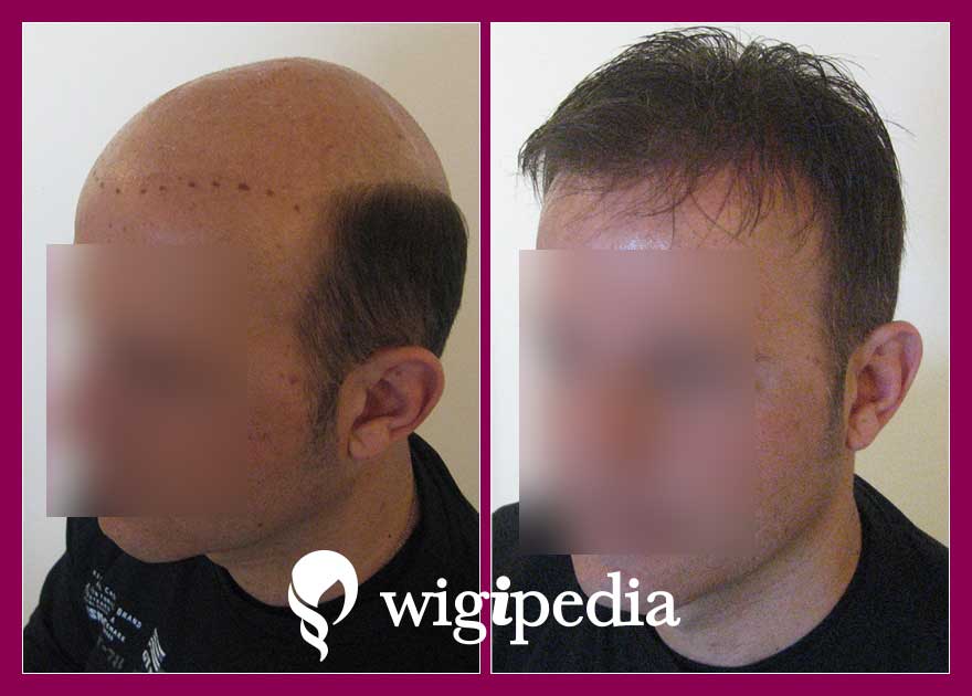 wigs-hair-prosthesis-eshop-wigipedia-results-men-before-after-031039PG-003