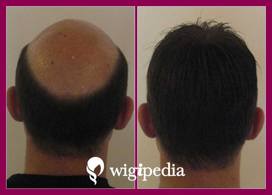 wigs-hair-prosthesis-eshop-wigipedia-results-men-before-after-031039PG-004