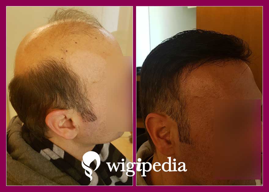 wigs-hair-prosthesis-eshop-wigipedia-results-men-before-after-035670PG-001