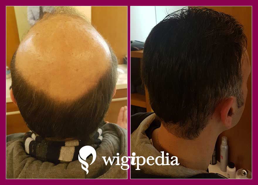 wigs-hair-prosthesis-eshop-wigipedia-results-men-before-after-035670PG-002