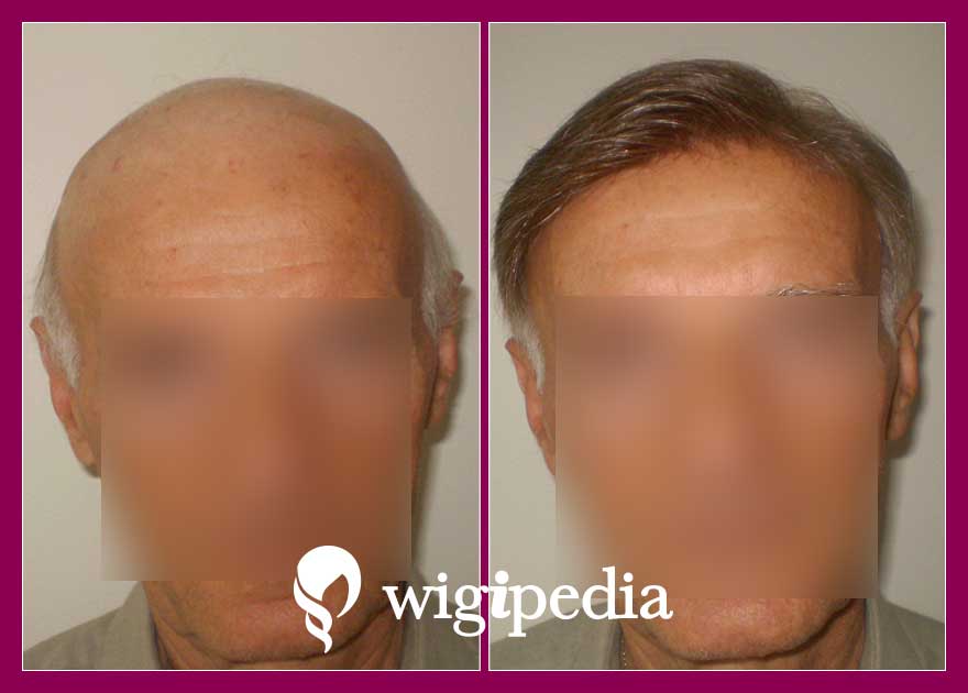 wigs-hair-prosthesis-eshop-wigipedia-results-men-before-after-043098PG-001