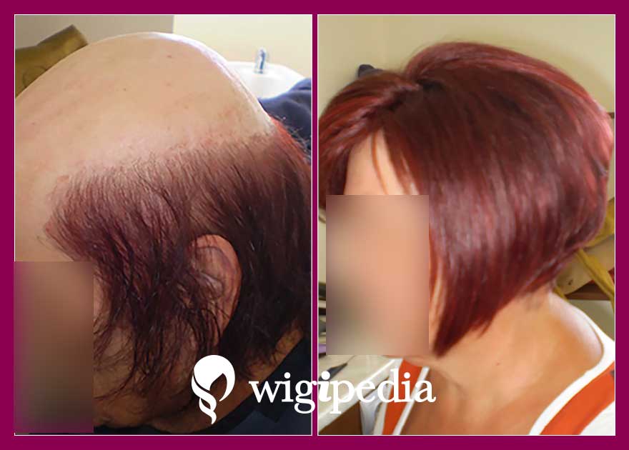 wigs-hair-prosthesis-eshop-wigipedia-results-women-before-after-010112PG-001