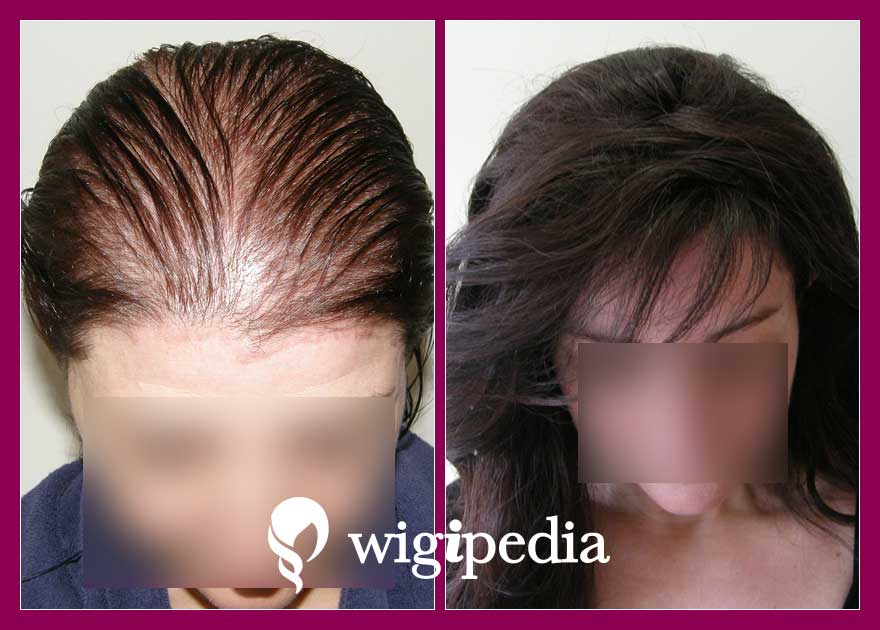 wigs-hair-prosthesis-eshop-wigipedia-results-women-before-after-010803PG-001