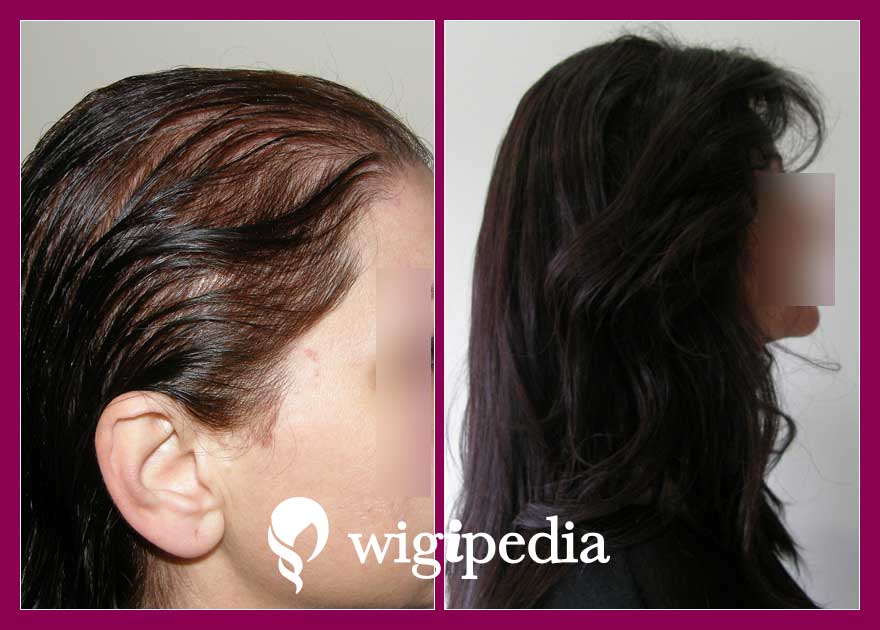 wigs-hair-prosthesis-eshop-wigipedia-results-women-before-after-010803PG-002