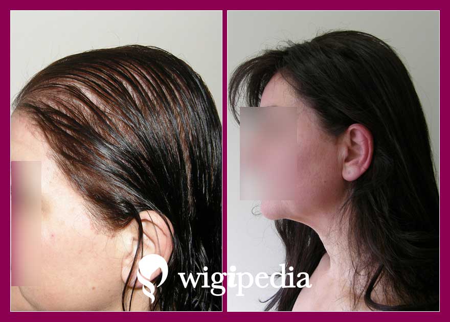 wigs-hair-prosthesis-eshop-wigipedia-results-women-before-after-010803PG-003