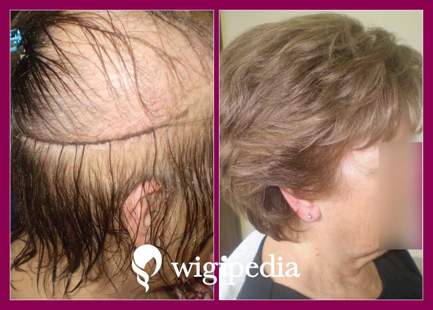 wigs-hair-prosthesis-eshop-wigipedia-results-women-before-after-020212PG-001