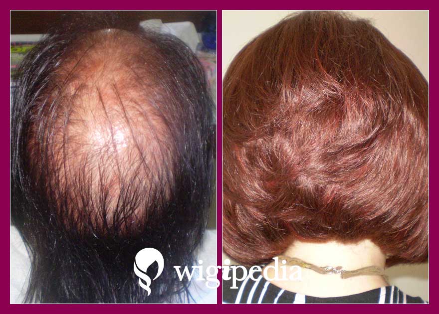 wigs-hair-prosthesis-eshop-wigipedia-results-women-before-after-020291PG-001