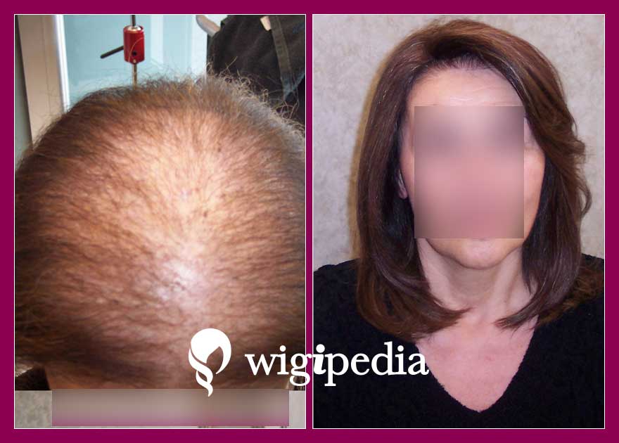 wigs-hair-prosthesis-eshop-wigipedia-results-women-before-after-027061PG-002