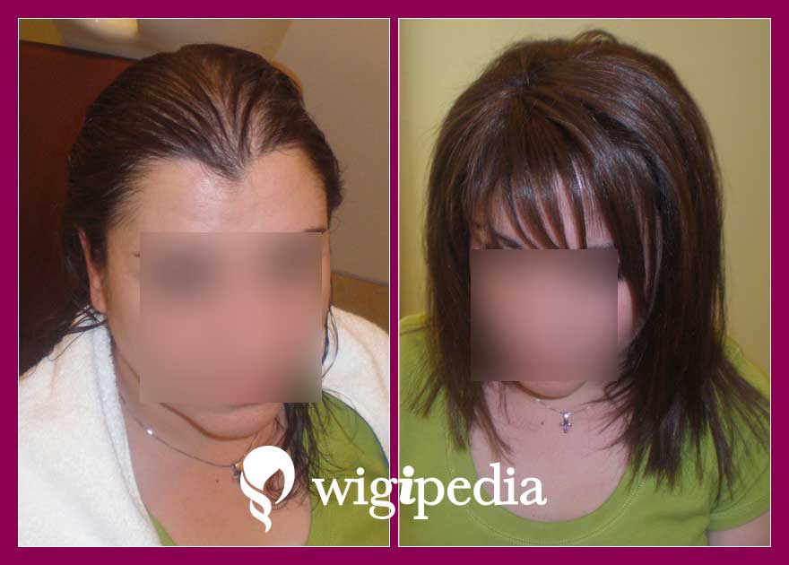 wigs-hair-prosthesis-eshop-wigipedia-results-women-before-after-043040PG-001