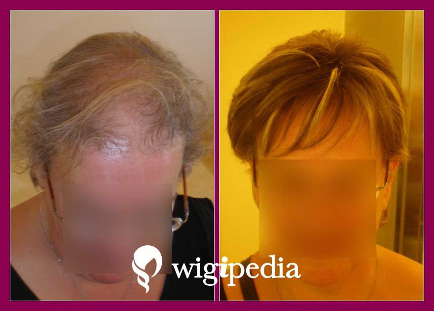 wigs-hair-prosthesis-eshop-wigipedia-results-women-before-after-065098PG-001