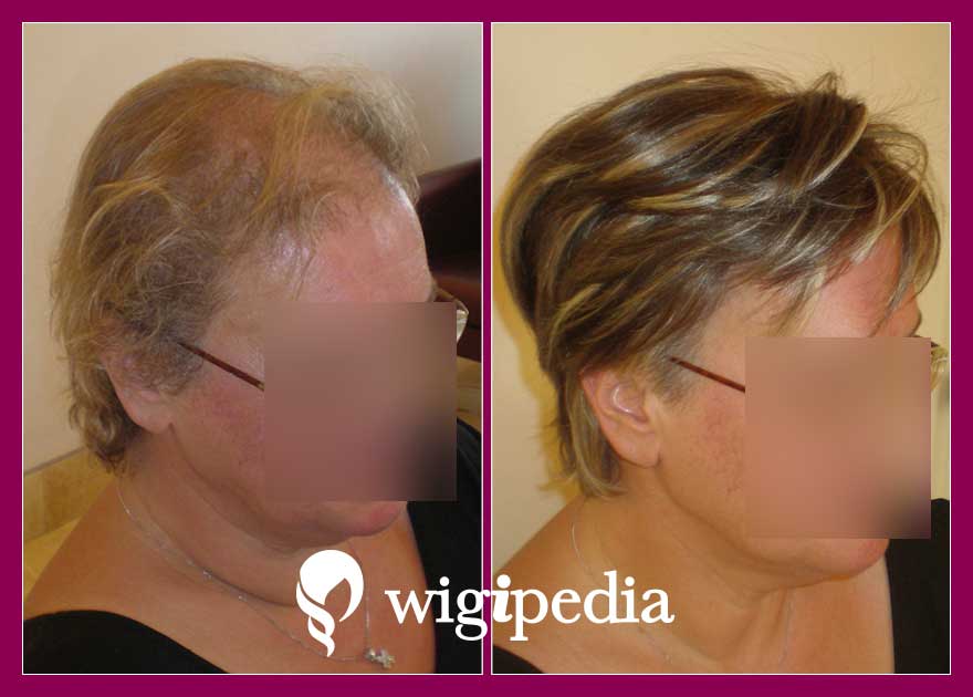 wigs-hair-prosthesis-eshop-wigipedia-results-women-before-after-065098PG-002